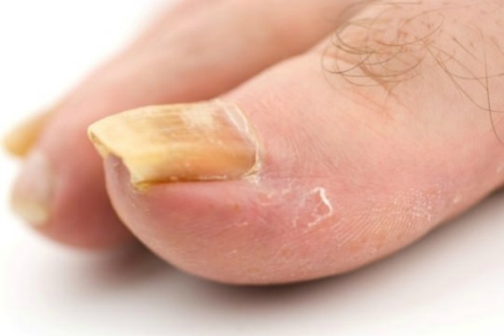 Is Apple Cider Vinegar Good For Toenail Fungus 