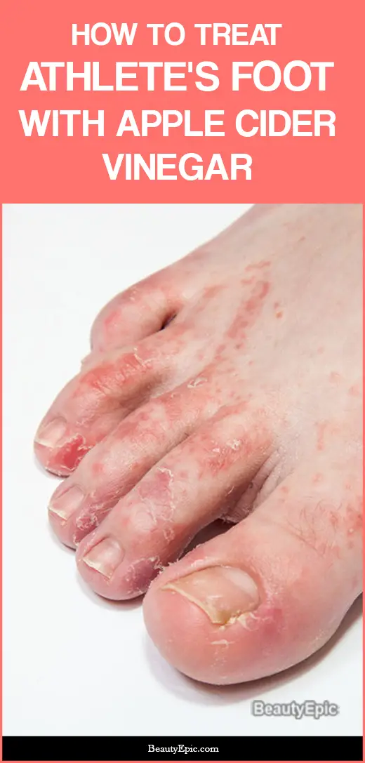 How To Get Rid Of Athlete s Foot With Apple Cider Vinegar 