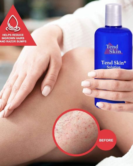 Tend skin solution 2