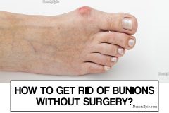 How To Get Rid Of Bunions Without Surgery? In 2024