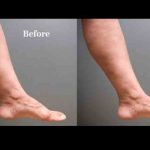 how to get rid of varicose veins naturally in 2 weeks