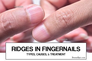 Ridges In Fingernails - Types, Causes And Treatment