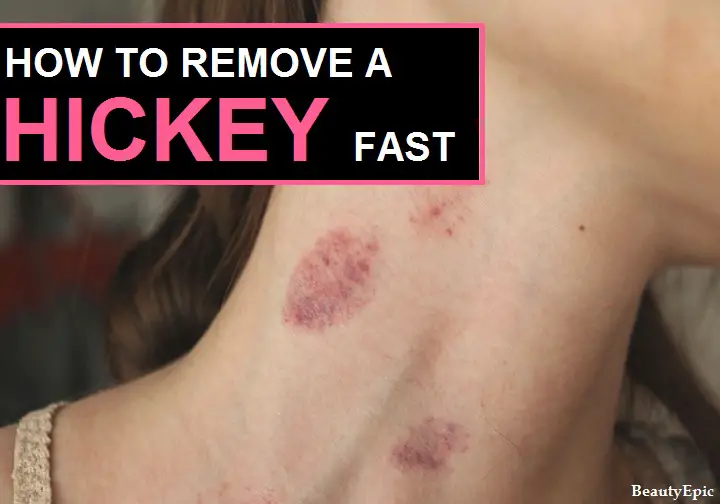 how to get rid of a hickey fast and easy 