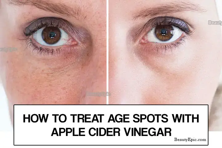 Tman's Apple Cider Vinegar - HOW TO FADE DARK SPOTS & SUNSPOTS ON