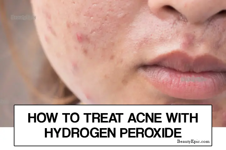 How To Use Hydrogen Peroxide For Acne 