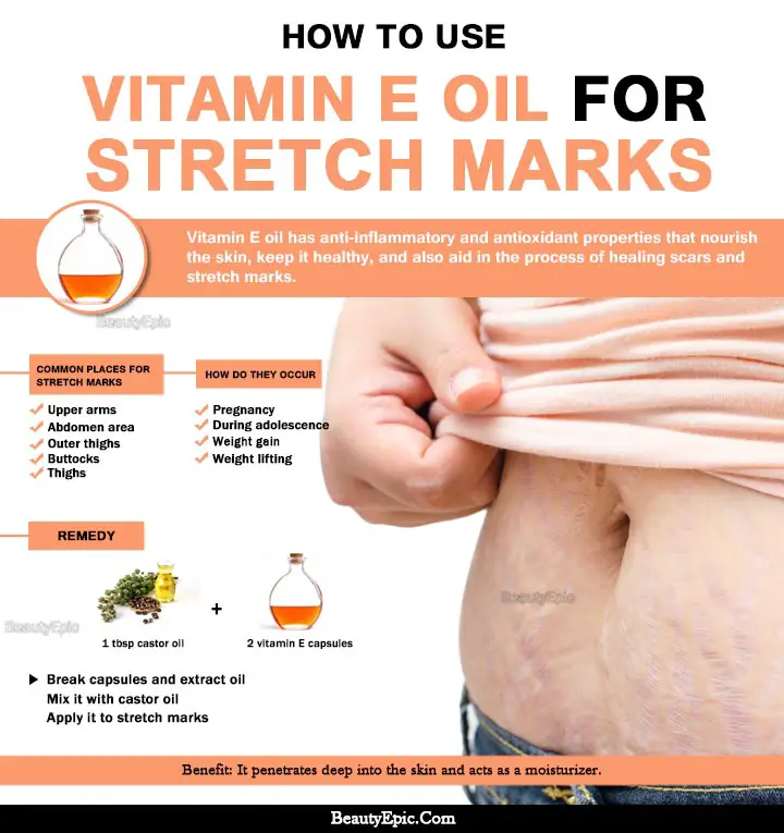 How To Use Vitamin E Oil To Get Rid Of Stretch Marks