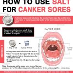 How to Use Garlic for Tooth Abscess?