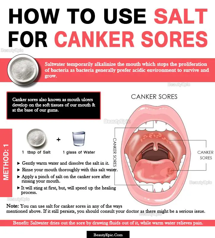 How Does Salt Help Heal Canker Sores 