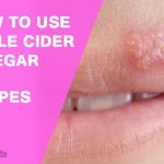 How Does Apple Cider Vinegar Help Cold Sores?