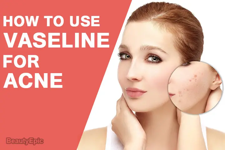 How To Use Vaseline For Acne 