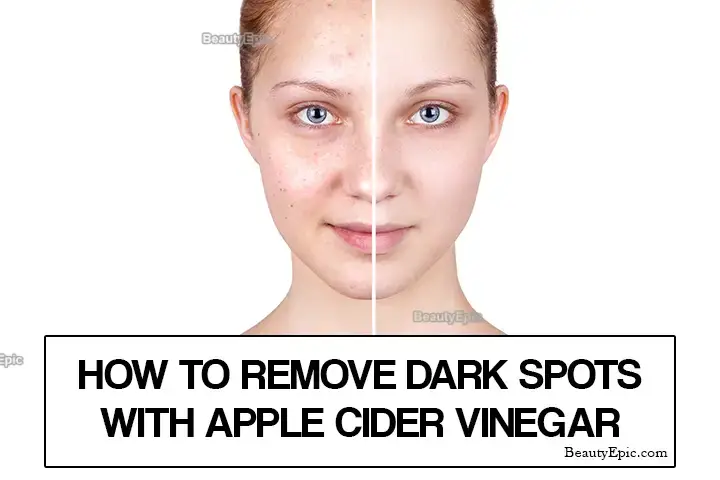 apple cider vinegar for dark spots