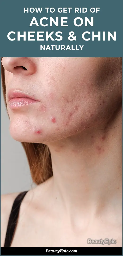 How To Get Rid Of Acne On Cheeks And Chin Naturally