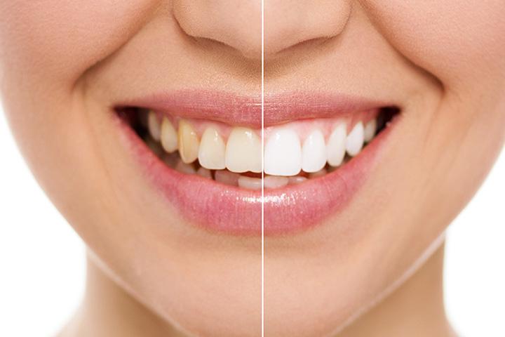 baking soda and coconut oil teeth whitening