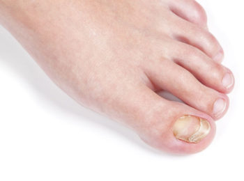 Is Vinegar And Epsom Salt Good For Toenail Fungus?