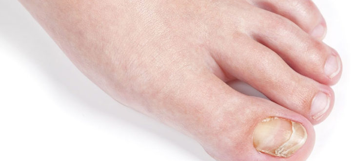 Is Vinegar And Epsom Salt Good For Toenail Fungus