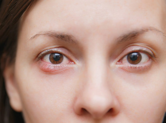 How To Get Rid Of A Stye Home Remedies And Prevention