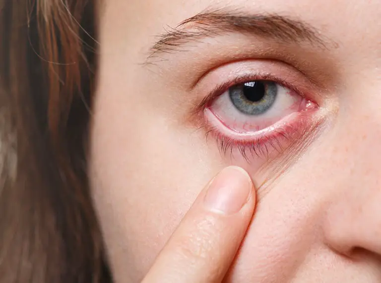 7 Effective Home Remedies To Treat Eye Infections